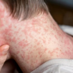 An expert has analyzed the measles health warning and revealed the “only way” to avoid an outbreak in the country