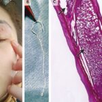A live worm, 11 cm long, was extracted from a woman’s eyelid in Romania