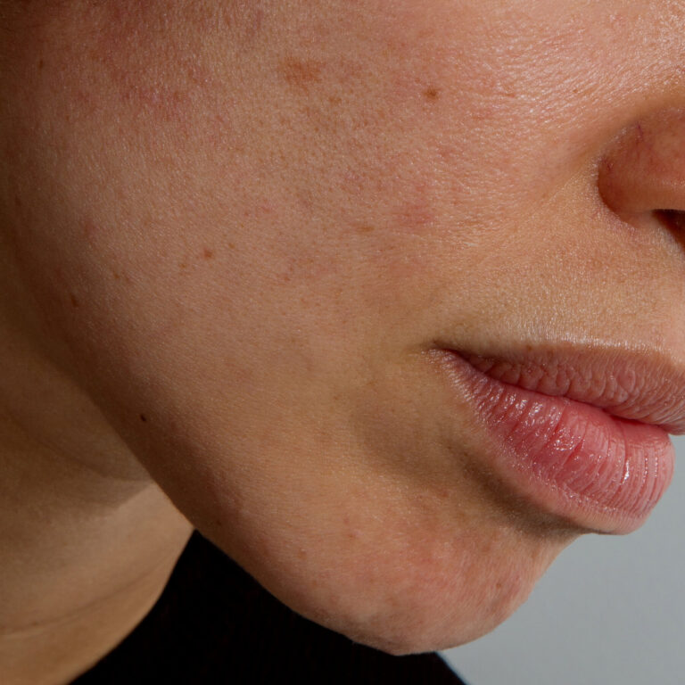 16WELL-ASK-ROSACEA3-gfqc-mediumSquareAt3X.jpg