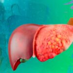 What types of cheese can I eat if I have fatty liver and which should I avoid to avoid further impact on the organ?