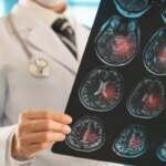 A vascular neurosurgeon points out the habit that increases the risk of stroke