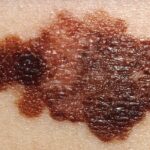 Melanoma.jpg