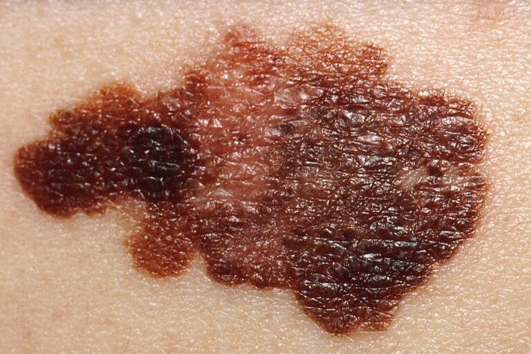 Melanoma.jpg