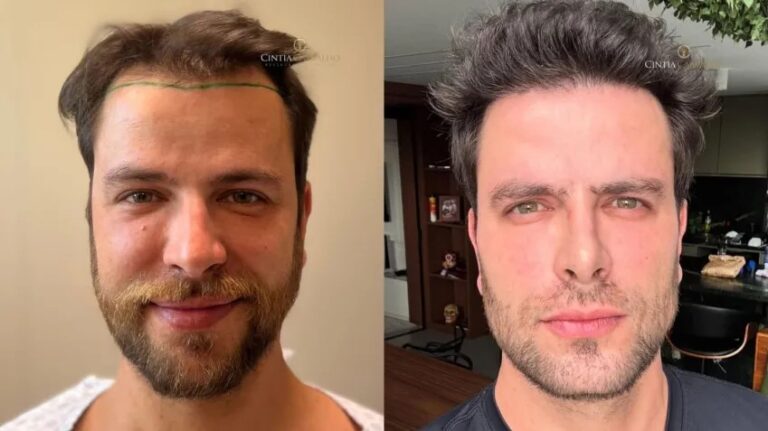 gustavo-marsengo-antes-e-depois.webp.jpeg