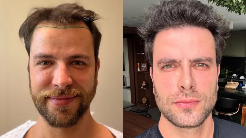 gustavo-marsengo-antes-e-depois.webp.jpeg