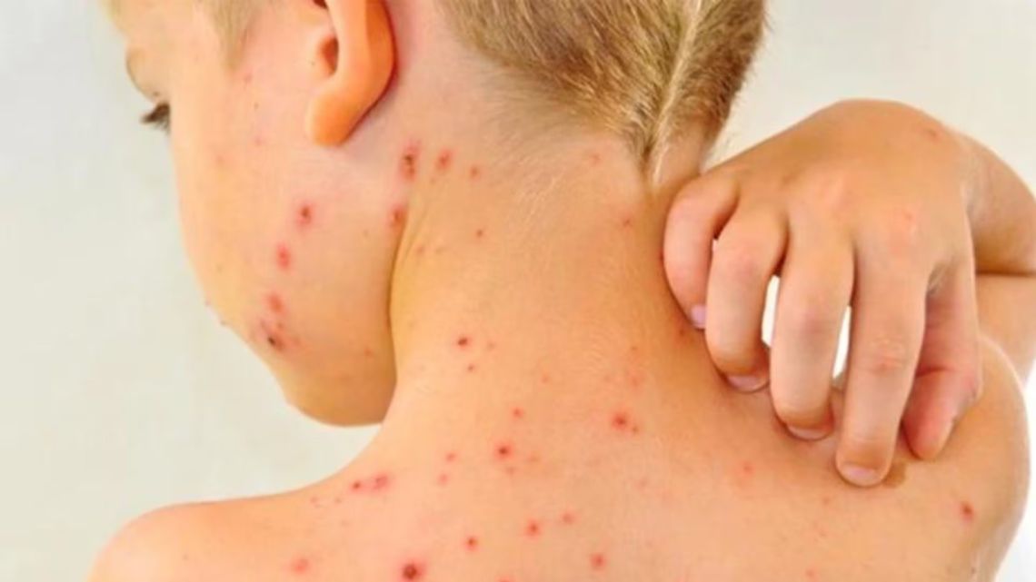 sarampion-preocupa-aumento-de-casos-1978221.jpeg
